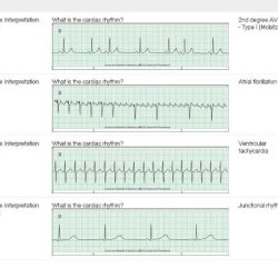 Dysrhythmia - advanced with measurements a