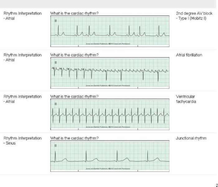 Dysrhythmia - advanced with measurements a