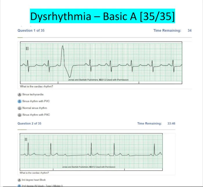 Dysrhythmia - advanced with measurements a