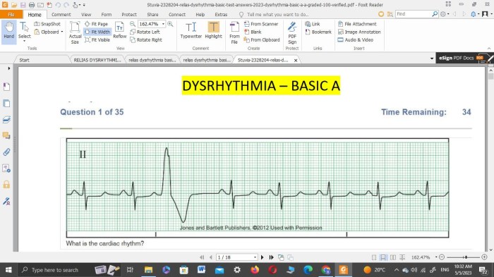 Dysrhythmia - advanced with measurements a